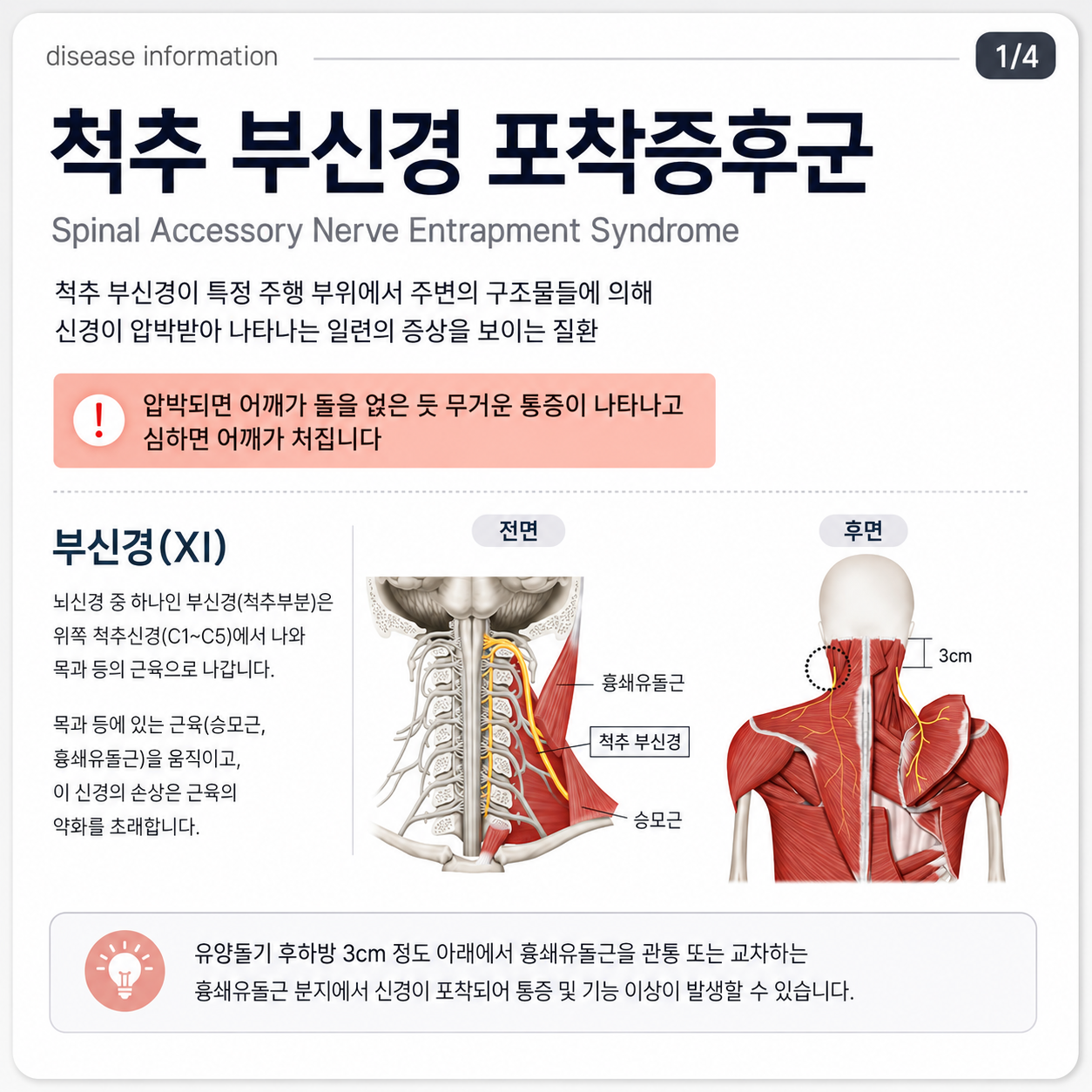 척추 부신경 포착증후군이란? 어깨가 무겁고 처질 때 확인해야 할 신경 문제