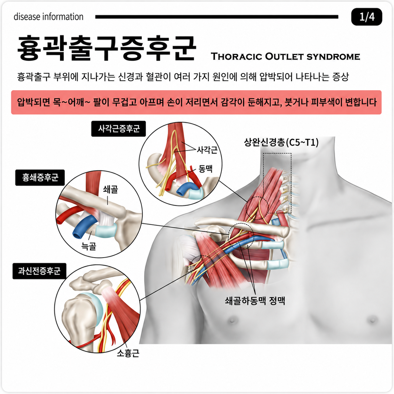 흉곽출구증후군이란? 원인, 증상, 자세와의 관계까지 쉽게 정리