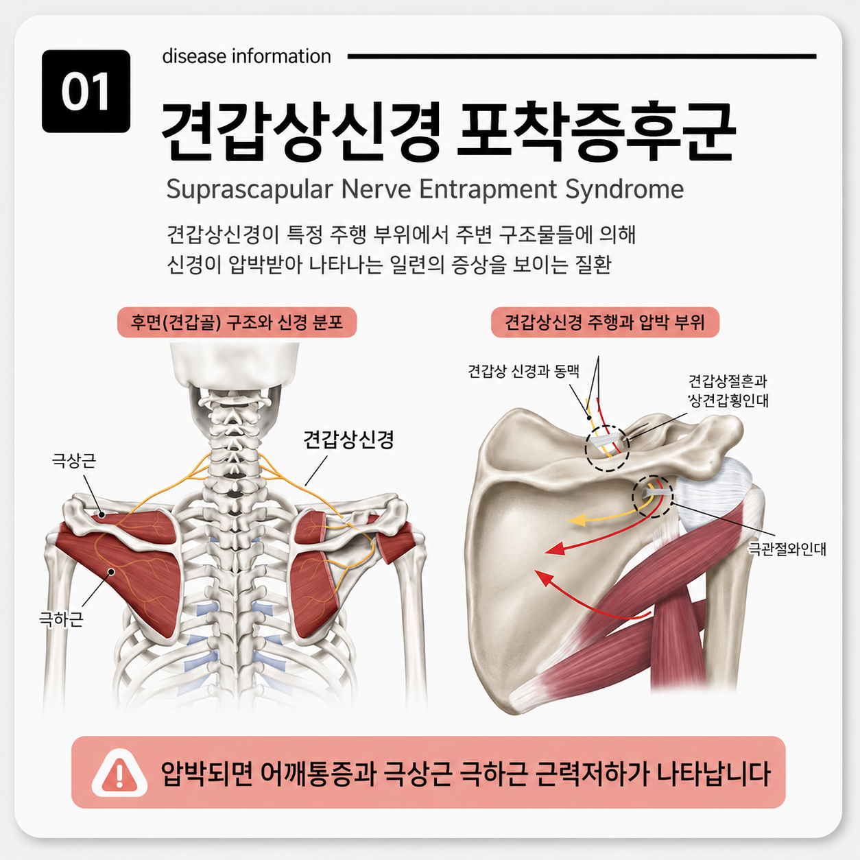 견갑상신경 포착증후군이란? 어깨 깊은 통증과 극상근·극하근 약화의 원인