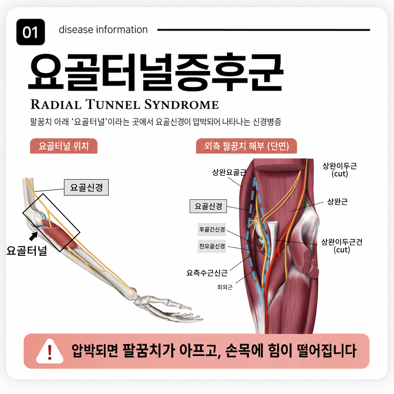 요골터널증후군이란? 팔꿈치 통증과 손목 힘 저하가 반복될 때 확인해야 할 신경 문제