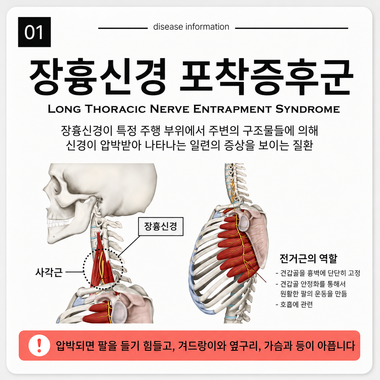 장흉신경 포착증후군이란? 날개견갑골·어깨 통증과 관련된 신경 문제 쉽게 정리
