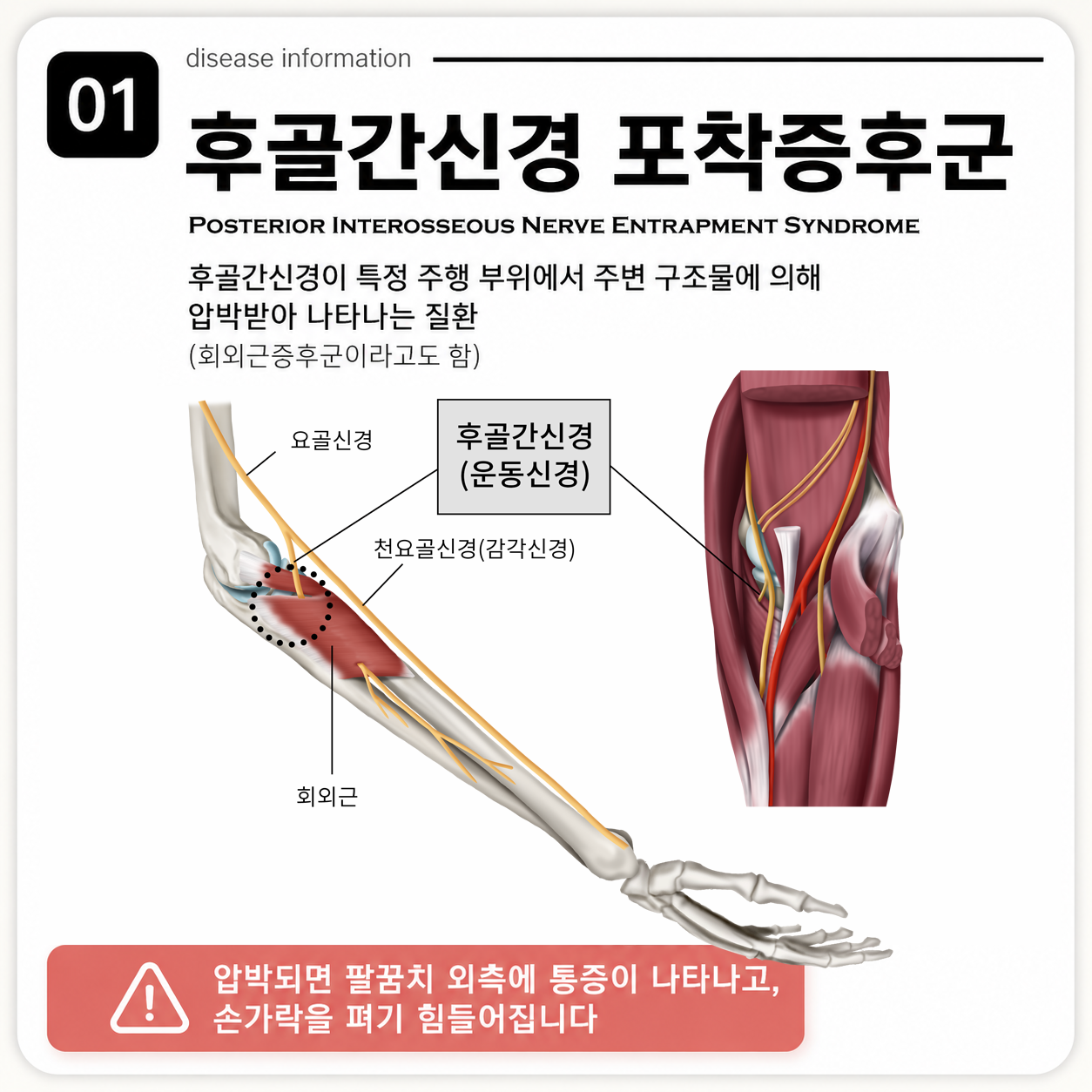 후골간신경 포착증후군이란? 팔꿈치 바깥 통증과 손가락 펴기 어려움이 나타나는 이유