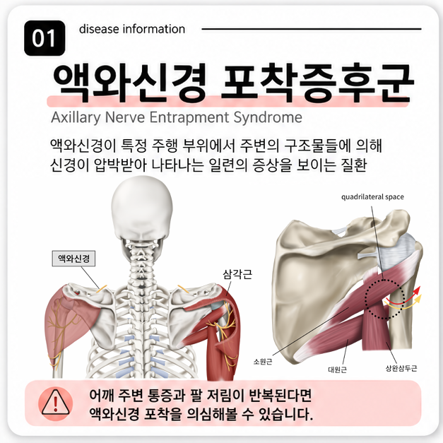 액와신경 포착증후군이란? 어깨 통증과 팔 저림이 반복될 때 확인할 신경 문제