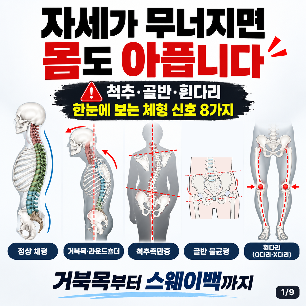 자세가 무너지면 몸도 아플까? 척추·골반·다리 정렬로 보는 체형 신호 8가지